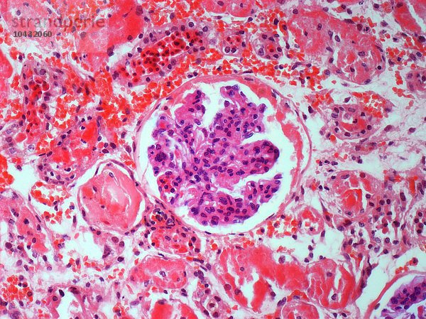 Nierenerkrankung. Lichtmikroskopische Aufnahme eines Schnitts durch eine entzündete Niere  die einen Glomerulus (gewundene Kapillaren  lila) zeigt. Er ist von Gefäßexsudat und nekrotischen Tubuli umgeben. Vergrößerung: x200 bei einer Druckbreite von 10 Zentimetern Nierenerkrankung  lichtmikroskopische Aufnahme