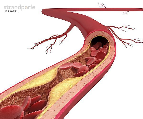 Atherosklerose. Computergrafik einer durch eine Cholesterinplaque verengten Arterie Atherosklerose  Kunstwerk