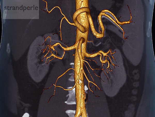 Abdominal-Aorta. Farbiges 3D-Computertomographie (CT)-Angiogramm der Bauchaorta eines 53 Jahre alten Patienten. Die Aorta ist die Hauptarterie des Körpers. Sie transportiert das Blut vom Herzen zum Rest des Körpers. In der Mitte links und rechts sind die Nieren zu sehen  wobei die Nierenarterien von der Aorta abzweigen. In der unteren Aorta befindet sich eine kleine fetthaltige Plaque (weiß  Atherosklerose). Bauchaorta  3D-CT-Scan