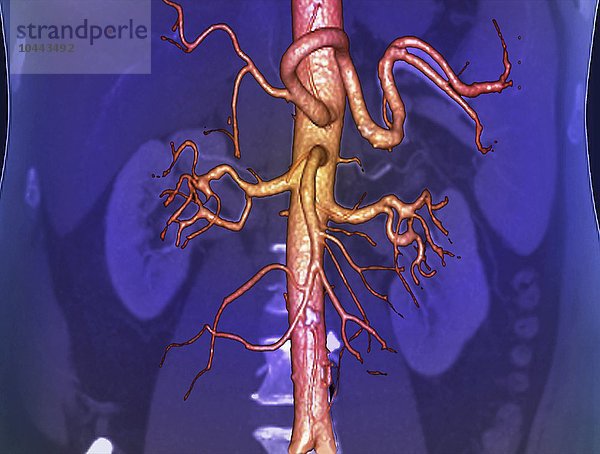 Abdominal-Aorta. Farbiges 3D-Computertomographie (CT)-Angiogramm der Bauchaorta eines 53 Jahre alten Patienten. Die Aorta ist die Hauptarterie des Körpers. Sie transportiert das Blut vom Herzen zum Rest des Körpers. In der Mitte links und rechts sind die Nieren zu sehen  wobei die Nierenarterien von der Aorta abzweigen. In der unteren Aorta befindet sich eine kleine fetthaltige Plaque (weiß  Atherosklerose). Bauchaorta  3D-CT-Scan