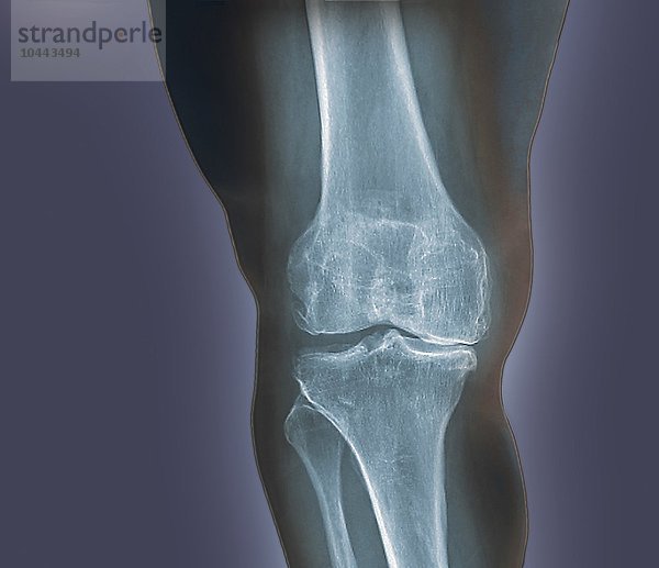 Arthrose im Knie. Farbige Röntgenaufnahme des Knies eines übergewichtigen 48-jährigen Patienten  die eine degenerative Arthritis zeigt  die durch die extreme Belastung des Knies durch Übergewicht verursacht wird. Oben ist der Oberschenkelknochen (Femur) zu sehen  unten das Schienbein (Tibia)  rechts daneben das kleinere Wadenbein (Fibula). Bei einem gesunden Menschen ist in der Regel ein deutlicher Abstand zwischen Oberschenkelknochen und Schienbein vorhanden. Bei Arthrose kommt es zu einem Verlust des Knorpels zwischen den Gelenken. Der Heilungsprozess führt dazu  dass anstelle des Knorpels Knochen wächst  was zu Schmerzen  Steifheit und Bewegungseinschränkungen führt. Arthritis des Knies  Röntgenbild