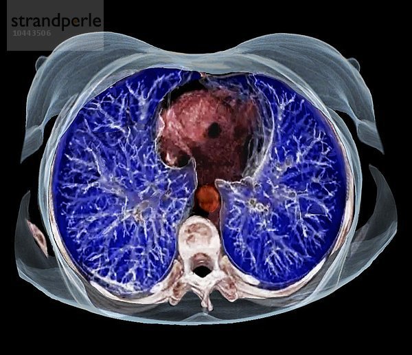 Anatomie des Brustkorbs. Farbige 3D-Computertomographie (CT) eines Querschnitts durch den Brustkorb eines 54-jährigen Patienten. Die Lunge ist blau. Unten ist die Wirbelsäule (weiß) und oben das Herz (rot). In der Mitte befindet sich die Aorta (rot)  die Hauptschlagader des Körpers Brustkorbanatomie  3D-CT-Scan