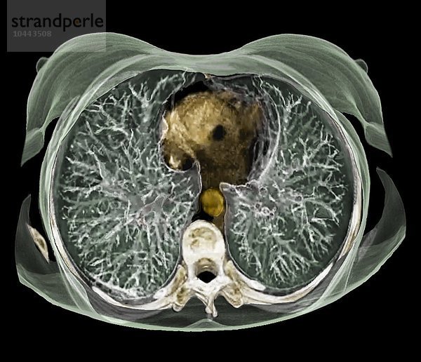 Anatomie des Brustkorbs. Farbige 3D-Computertomographie (CT) eines Querschnitts durch den Brustkorb eines 54-jährigen Patienten. Die Lunge ist grün. Unten ist die Wirbelsäule (weiß) und oben das Herz (braun). In der Mitte befindet sich die Aorta (gelb)  die Hauptschlagader des Körpers Anatomie des Brustkorbs  3D-CT-Scan