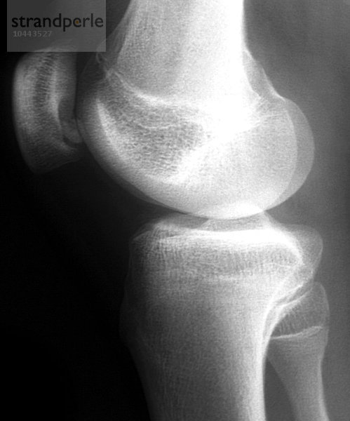 Erkrankung des Knies. Röntgenbild des rechten Knies eines 18-jährigen Patienten mit Osteochondritis dissecans (OCD) des Knies. Ein kleines Stück Knochen und Knorpel hat sich von der Rückseite der Kniescheibe (Patella  oben links) gelöst. Die abgetrennten Stücke können an Ort und Stelle bleiben oder in das Gelenk fallen. OCD verursacht Schmerzen und Schwellungen und  wenn sich der Knochen verschoben hat  eine Blockierung des Gelenks. Knieerkrankung  Röntgenbild