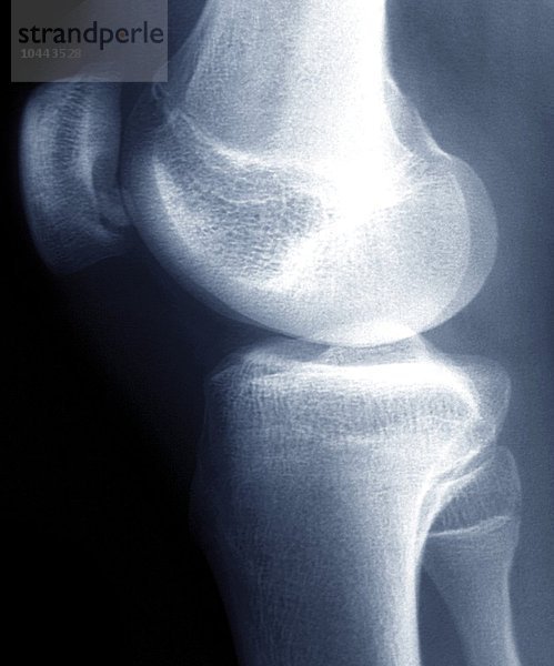 Erkrankung des Knies. Farbige Röntgenaufnahme des rechten Knies eines 18-jährigen Patienten mit Osteochondritis dissecans (OCD) des Knies. Ein kleines Stück Knochen und Knorpel hat sich von der Rückseite der Kniescheibe (Patella  oben links) gelöst. Die abgetrennten Stücke können an Ort und Stelle bleiben oder in das Gelenk fallen. OCD verursacht Schmerzen und Schwellungen und  wenn sich der Knochen verschoben hat  eine Blockierung des Gelenks. Knieerkrankung  Röntgenbild