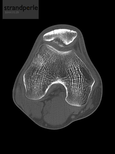Erkrankung des Knies. Axiale Computertomographie (CT) des rechten Knies eines 18-jährigen Patienten mit Osteochondritis dissecans (OCD) des Knies. Ein kleines Stück Knochen und Knorpel hat sich von der Rückseite der Kniescheibe (Patella  oben) gelöst. Die abgetrennten Stücke können an Ort und Stelle bleiben oder in das Gelenk fallen. Die OCD verursacht Schmerzen und Schwellungen und  wenn sich der Knochen bewegt hat  eine Blockierung des Gelenks. Knieerkrankung  CT-Scan