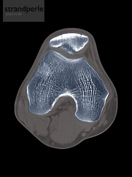 Erkrankung des Knies. Farbige axiale Computertomografie (CT) des rechten Knies eines 18-jährigen Patienten mit Osteochondritis dissecans (OCD) des Knies. Ein kleines Stück Knochen und Knorpel hat sich von der Rückseite der Kniescheibe (Patella  oben) gelöst. Die abgetrennten Stücke können an Ort und Stelle bleiben oder in das Gelenk fallen. Die OCD verursacht Schmerzen und Schwellungen und  wenn sich der Knochen bewegt hat  eine Blockierung des Gelenks. Knieerkrankung  CT-Scan