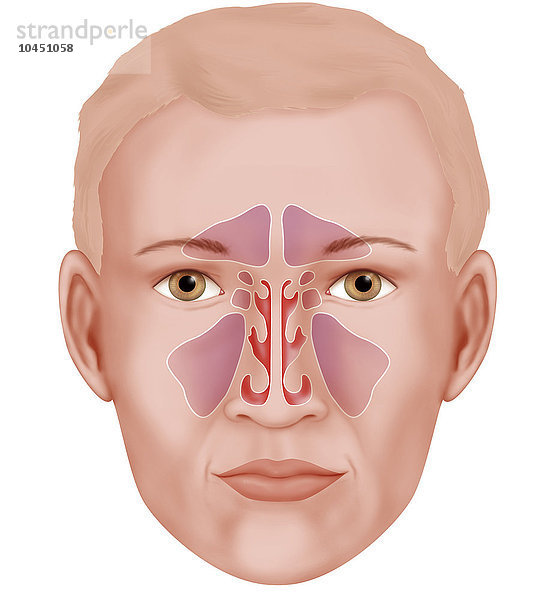 Illustration der verschiedenen Nasennebenhöhlen (violett). Von oben nach unten: Stirnhöhle (dreieckig)  Keilbeinhöhle  Siebbeinhöhle und Kieferhöhle. Zwischen diesen Nasennebenhöhlen befinden sich die Nasengänge (obere  mittlere und untere).