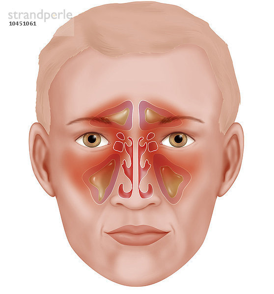 Illustration der verschiedenen Nasennebenhöhlen  die bei einer Sinusitis mit zähem Schleim und Schwellungen infiziert sind. Von oben nach unten: Stirnhöhle  Keilbeinhöhle  Siebbeinhöhle und Kieferhöhle.