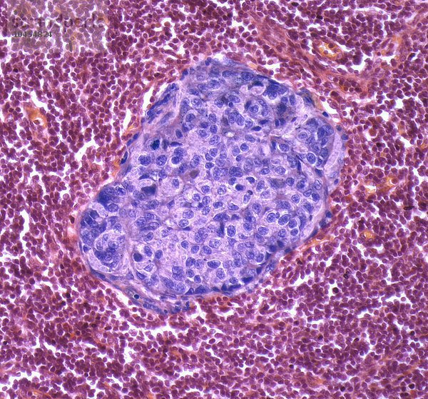 Metastasierender Brustkrebs. Lichtmikroskopische Aufnahme eines Schnittes durch einen Lymphknoten mit einem bösartigen (violetten) Tumor  der aus der Brust stammt. Vergrößerung: x200 bei einer Druckbreite von 10 Zentimetern Metastasierter Brustkrebs