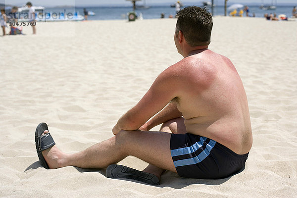 MODELL FREIGEGEBEN. Sonnenbrand. Mann mit sonnenverbrannten Schultern am Strand sitzend. Sonnenbrand wird durch übermäßige Sonneneinstrahlung verursacht. Die ultraviolette Strahlung des Sonnenlichts zerstört die Zellen der äußeren Hautschicht und schädigt die winzigen Blutgefäße darunter. Die betroffene Haut entzündet sich und kann Blasen werfen. Einige Tage später schälen sich die abgestorbenen Zellen ab. Sonnenbrand tritt am häufigsten bei hellhäutigen Menschen auf  deren Haut das schützende Pigment Melanin fehlt. Wiederholte Sonnenbestrahlung kann die Haut vorzeitig altern lassen und erhöht das Risiko von Hautkrebs. Galmei-Lotion und Schmerzmittel können helfen  einen Sonnenbrand zu lindern  aber in schweren Fällen ist ärztliche Hilfe und die Verabreichung von Kortikosteroiden erforderlich. Sonnenbrand