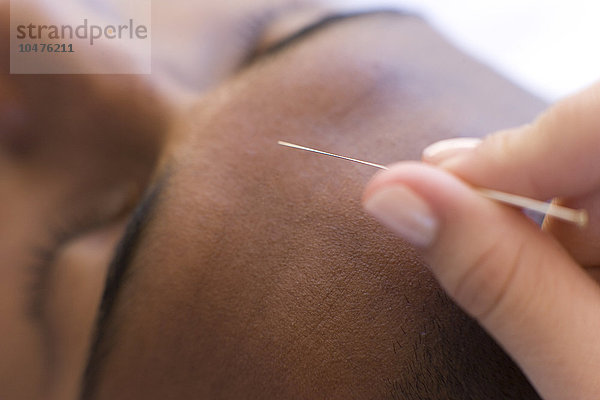 MODELL FREIGEGEBEN. Akupunktur. Ein Akupunkteur führt eine Nadel in die Stirn eines Kunden ein. Akupunktur wird zur Schmerzlinderung und zur Behandlung einer Vielzahl von Erkrankungen eingesetzt. Akupunktur