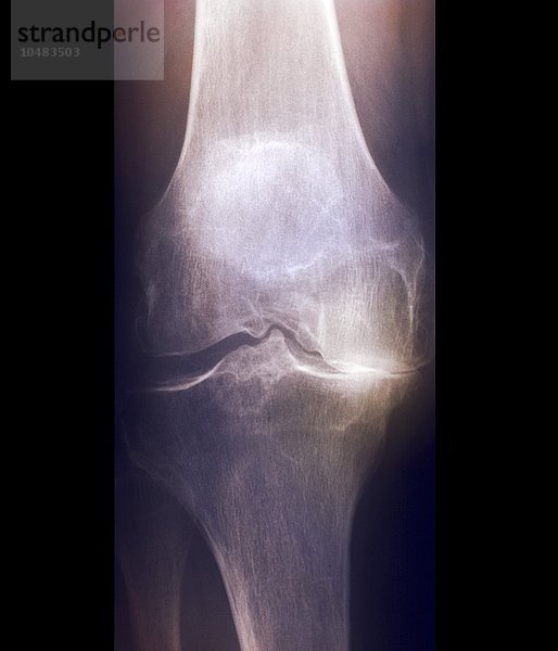 Arthritis des Knies. Frontal gefärbte Röntgenaufnahme des Knies eines 59-jährigen Patienten mit Arthritis Arthritis des Knies  Röntgenbild