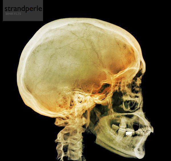 Normaler Schädel. Farbiges Röntgenbild des Kopfes eines 28-jährigen Patienten  normaler Schädel  Röntgenbild