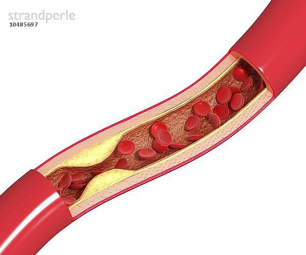 Atherosklerose. Computergrafik einer durch eine Cholesterinplaque verengten Arterie Atherosklerose  Kunstwerk