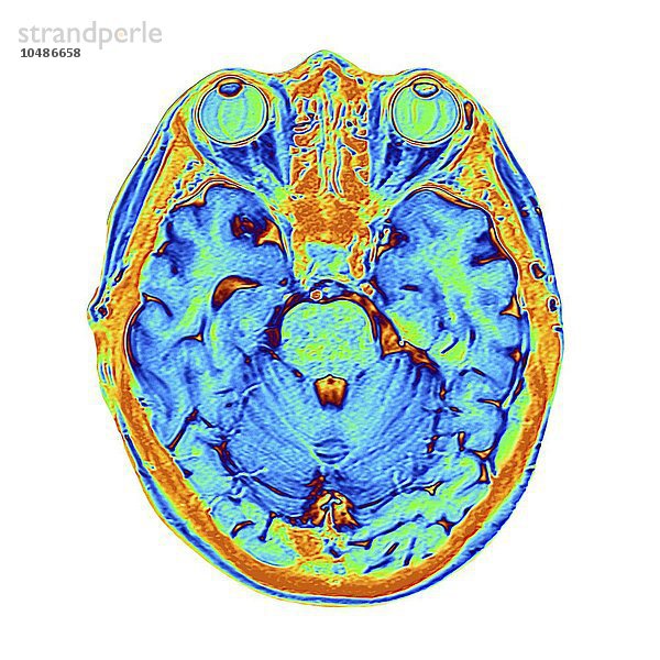 Gehirn-Scan. Falschfarben-Magnetresonanztomographie (MRT) eines menschlichen Kopfes mit einem gesunden Gehirn in horizontaler Ansicht. Im oberen Rahmen sind die beiden Augäpfel zu sehen. Zwischen den Augen befindet sich die Nasenhöhle mit den Nasenmuscheln  dünnen  spiralförmigen Knochen. Das MRT-Scannen ist eine Diagnosetechnik  bei der ein starker Elektromagnet und Radiowellen Querschnittsbilder von Körperregionen erzeugen. Farbiger MRT-Scan des menschlichen Kopfes