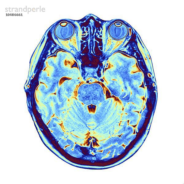 Gehirn-Scan. Falschfarben-Magnetresonanztomographie (MRT) eines menschlichen Kopfes mit einem gesunden Gehirn in horizontaler Ansicht. Im oberen Rahmen sind die beiden Augäpfel zu sehen. Zwischen den Augen befindet sich die Nasenhöhle mit den Nasenmuscheln  dünnen  spiralförmigen Knochen. Das MRT-Scannen ist eine Diagnosetechnik  bei der ein starker Elektromagnet und Radiowellen Querschnittsbilder von Körperregionen erzeugen. MRT-Gehirnscan