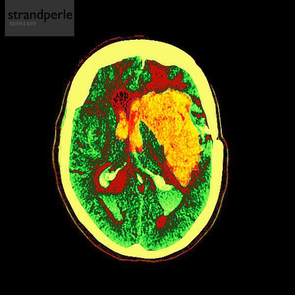 Hirnblutung. Magnetresonanztomographie (MRT) des Gehirns einer 74-jährigen Frau  die eine massive intrakranielle Blutung (gelb) hatte. Hirnblutung  MRT-Scan