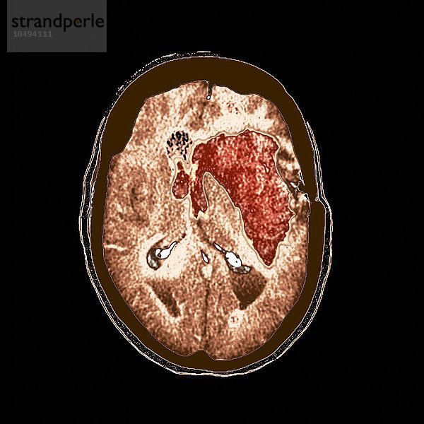 Hirnblutung. Magnetresonanztomographie (MRT) des Gehirns einer 74-jährigen Frau  die eine massive intrakranielle Blutung (rot) erlitten hat. Hirnblutung  MRT-Scan