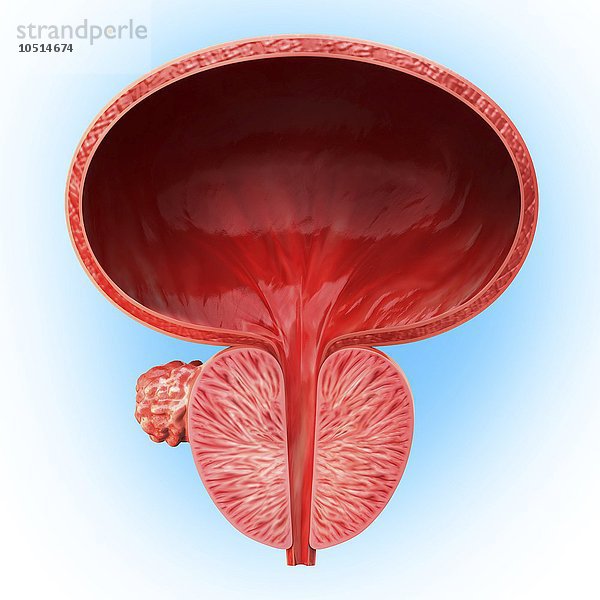 Menschlicher Prostatadrüsentumor  ausgeschnittene Computergrafik  Prostatadrüsentumor  Grafik