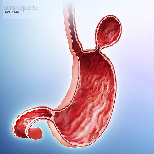 Menschlicher Magen mit Hernie  Ausschnitt aus einem Computerbild Menschlicher Magen mit Hernie  Kunstwerk
