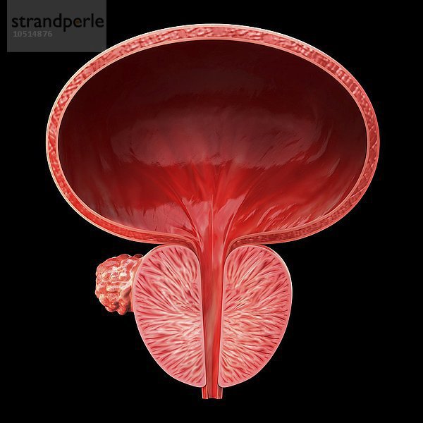 Menschlicher Prostatadrüsentumor  ausgeschnittene Computergrafik  Prostatadrüsentumor  Grafik