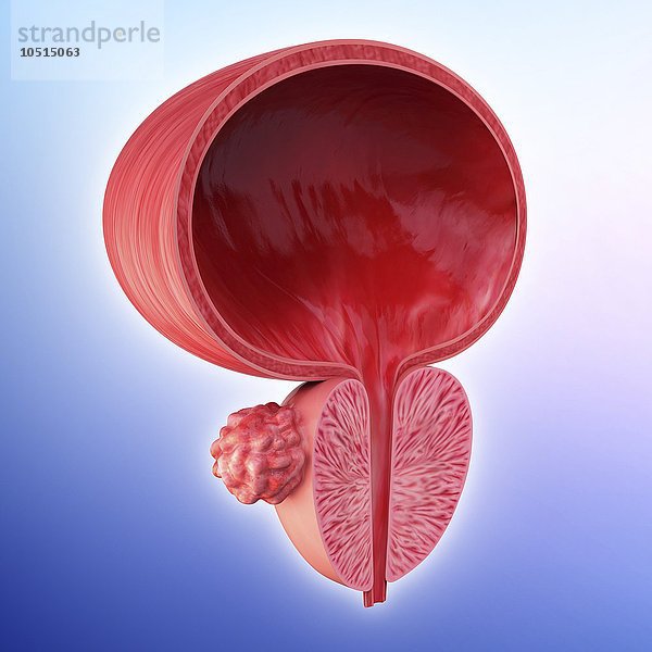 Menschlicher Prostatadrüsentumor  ausgeschnittene Computergrafik  Prostatadrüsentumor  Grafik