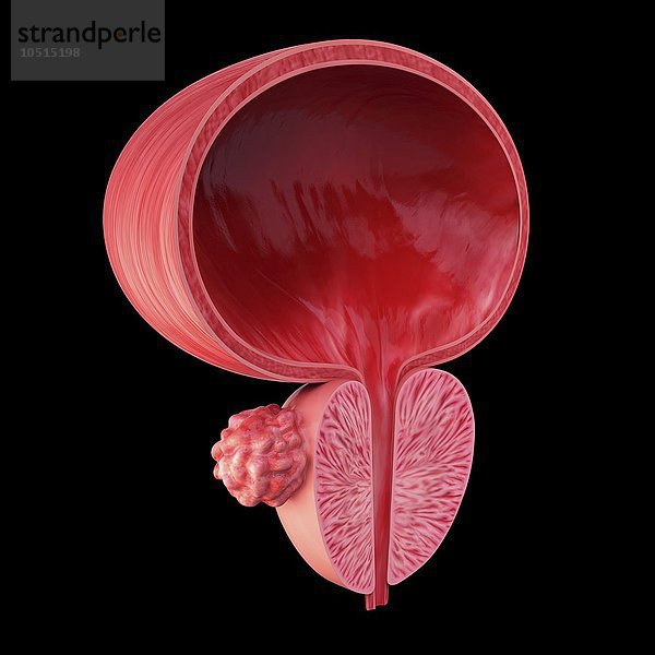 Menschlicher Prostatadrüsentumor  ausgeschnittene Computergrafik  Prostatadrüsentumor  Grafik