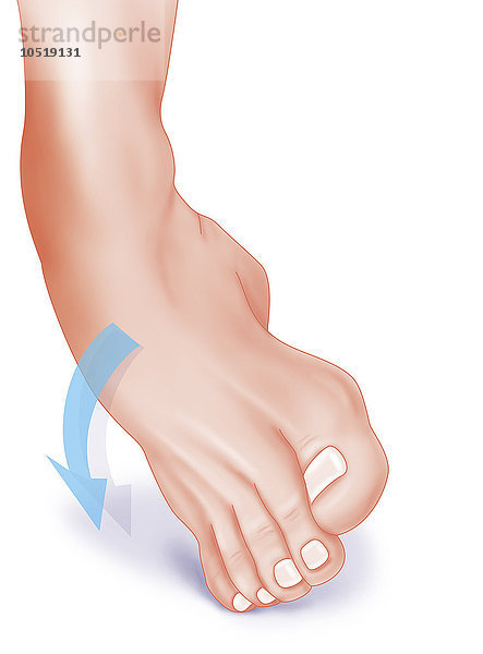 Abbildung eines Knöchels mit Umknickung des Fußes  die einen Bänderriss an der Außenseite des Knöchels verursachen kann.