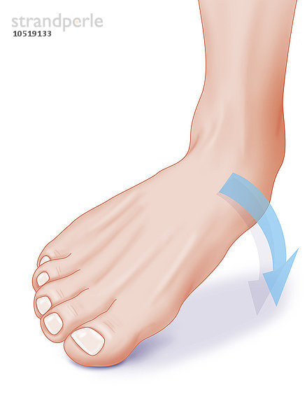 Abbildung eines Knöchels mit einer Ausweichbewegung des Fußes  die einen Bänderriss an der Innenseite des Knöchels verursachen kann.