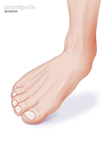 Abbildung eines Knöchels mit einer Ausweichbewegung des Fußes  die einen Bänderriss an der Innenseite des Knöchels verursachen kann.