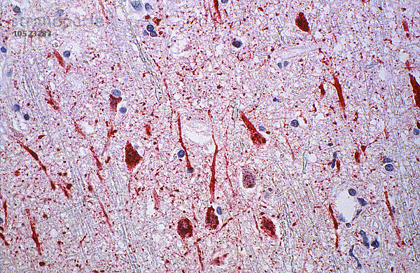 Dieses Mikrofoto einer menschlichen Gewebeprobe des zentralen Nervensystems (ZNS) zeigt einige der zytoarchitektonischen histopathologischen Veränderungen  die mit einer Infektion mit dem Nipah-Virus einhergehen  unter Verwendung immunhistochemischer (IHC) Techniken. Die Infektion mit dem Nipah-Virus hat