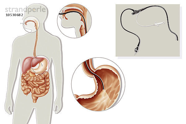 Gastroskopie  Illustration