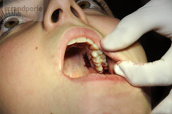 Gingivatransplantat. Entnahme des Transplantats und Nähen. Der Zahnarzt entfernt ein Stück Zahnfleisch aus dem Gaumen. Die Schleimhaut wird entweder oberhalb oder unterhalb des Periosts entfernt. Das Periost ist die Membran  die den Knochen bedeckt.