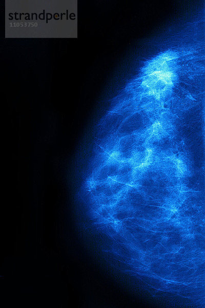 Brustkrebs (Adenokarzinom)  gesehen in einer Mammographie.