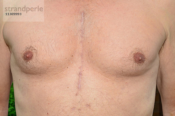 Brust eines Mannes  der sich 7 Monate zuvor einer Operation am offenen Herzen unterzogen hat  die zeigt  wie die Narben verheilt sind.