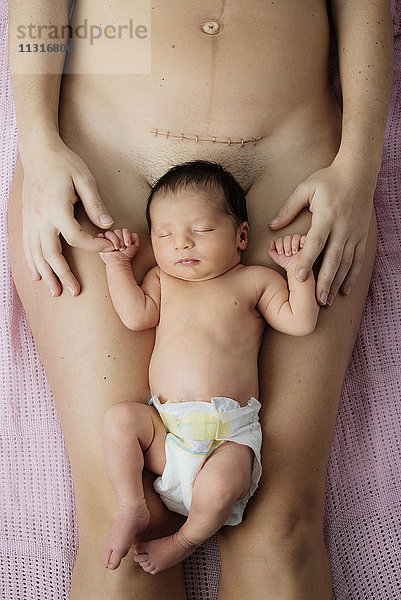 Neugeborenes Mädchen liegt auf den Oberschenkeln der Mutter in der Nähe einer neueren Kaiserschnittnarbe mit Klammern.