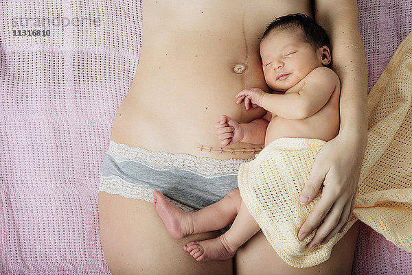 Neugeborenes Mädchen liegt auf den Oberschenkeln der Mutter in der Nähe einer neueren Kaiserschnittnarbe mit Klammern.