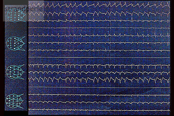 Schlafapnoe  die auf einem EEG (Elektroenzephalogramm) zu sehen ist.
