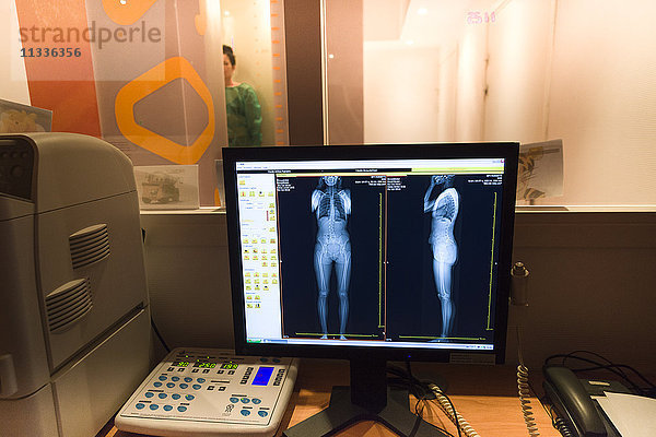 Reportage über das Gesundheitszentrum Rossetti in Nizza  Frankreich. Dieses Rehabilitationszentrum ist ein Kompetenzzentrum mit Spitzentechnologie. Das strahlungsarme EOS-Radiologiesystem: Es ermöglicht die gleichzeitige Erstellung von Frontal- und Profilbildern von Kopf bis Fuß am stehenden Patienten und die 3D-Rekonstruktion aller osteoartikulären Bereiche mit einer erheblichen Reduzierung der Röntgenstrahlenbelastung. Ein Sportpatient mit einer Knieverletzung und Gelenkrheumatismus. Es wird auch eine schwere Skoliose festgestellt.