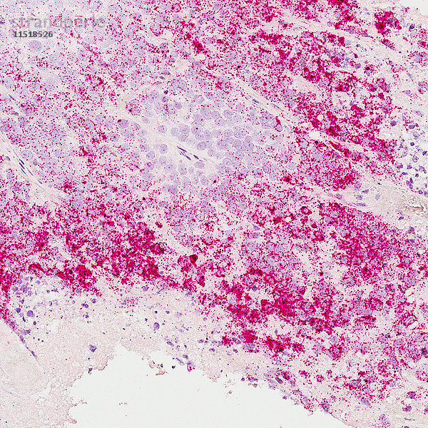 Mikroskopische Vollbild-Aufnahme von Brustkrebszellen