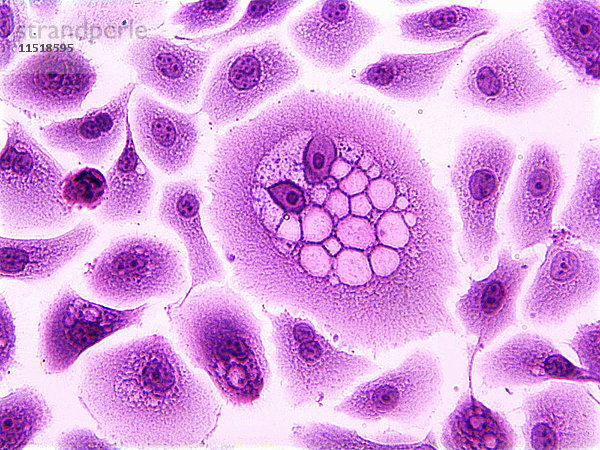 Koilozyten  Plattenepithelzellen  verändert durch humanes Papillomavirus