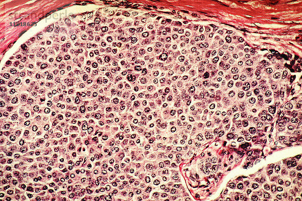 Mikroskopische Aufnahme von Brustkrebszellen