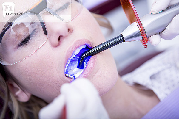 Aushärtung der Zahnfüllung beim Zahnarzt