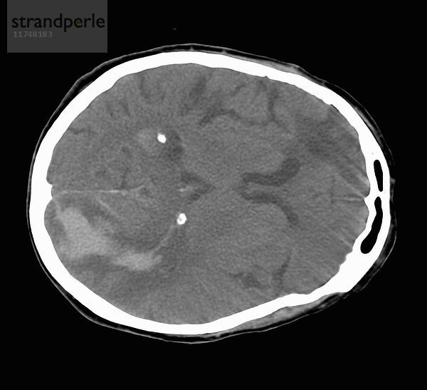 CT-Aufnahme des Gehirns  die einen Schlaganfall zeigt
