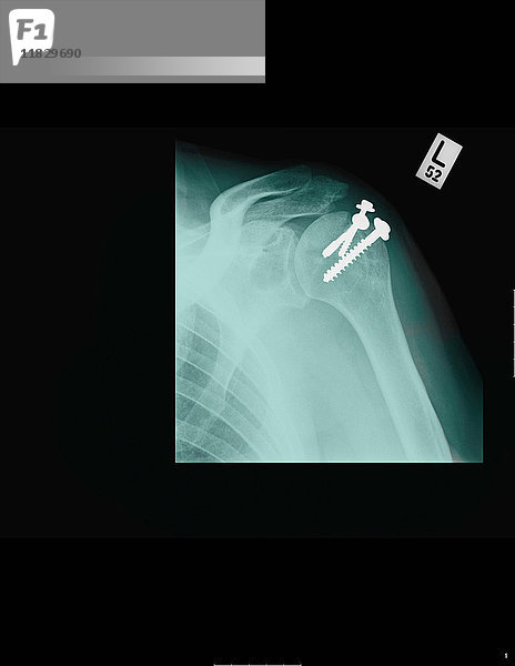 Röntgenbild mit Schulterschrauben