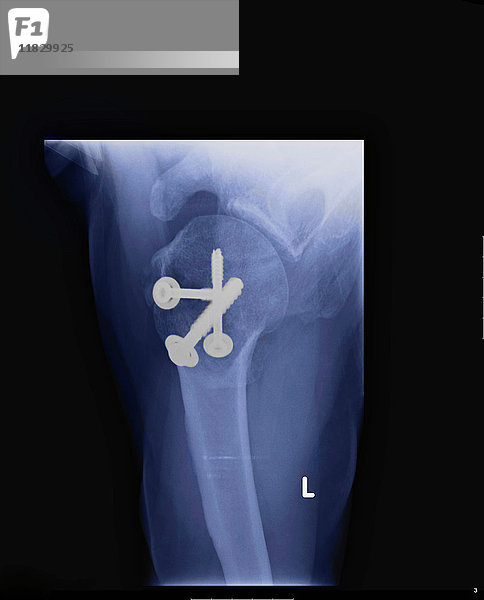 Röntgenbild mit Schulterschrauben