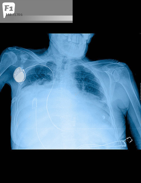 Röntgenbild zeigt Dyspnoe in der Brust