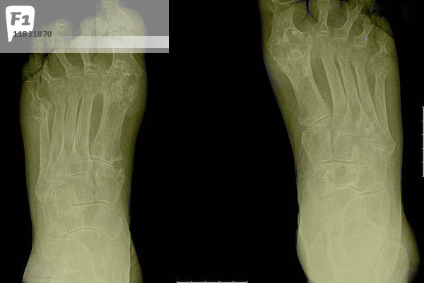 Röntgenbild mit arthritischen Füßen