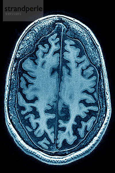 Zerebrale Atrophie (anterior temporal und parietal frontal pontocerebellar) Radialschnitt-MRT-Schädelaufnahme.